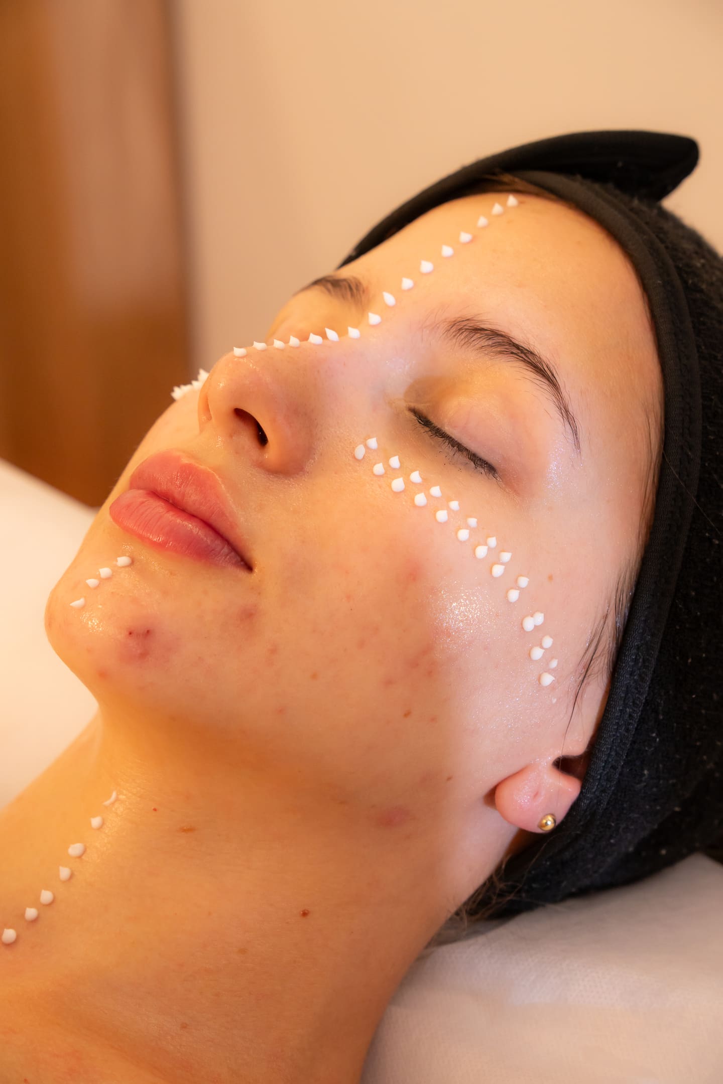 Rostro de perfil con puntos de tratamiento facial marcados sobre la piel